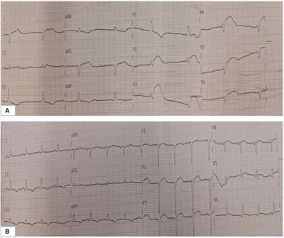 Case Report: Extended cardiopulmonary resuscitation in sudden cardiac arrest after acute myocardial infarction